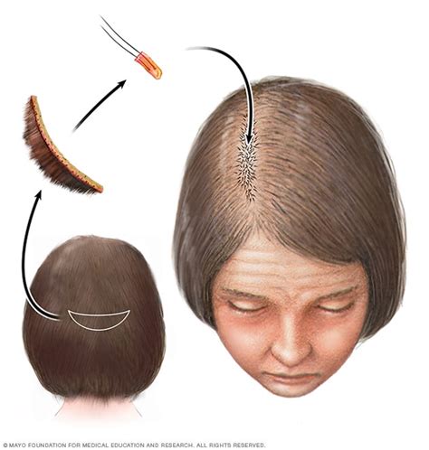 Hair loss - Diagnosis and treatment (2023)