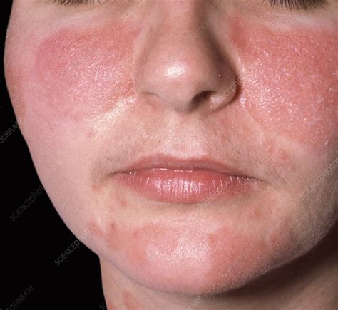 Seborrheic Dermatitis Face Women