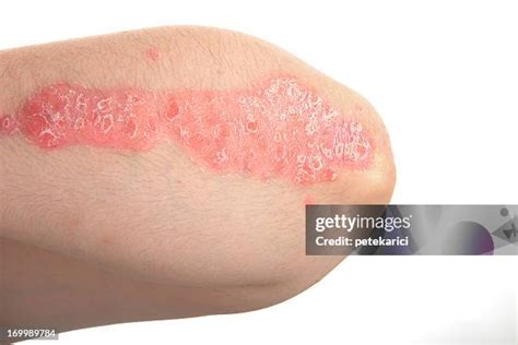 182 Psoriasis Cream Stock Photos, High-Res Pictures, and Images - Getty Images