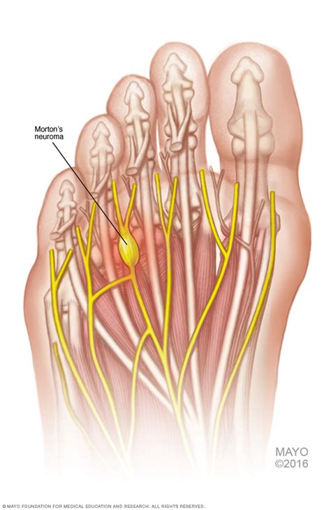 Is it a Bird? Is it a Plane? No, it’s a Morton’s Neuroma! – Border Podiatry Centre