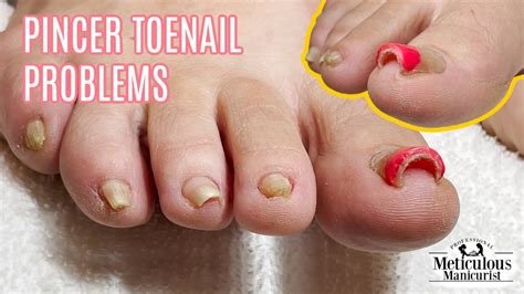 Pedicure Tutorial on Pincer Toenails that Cause Pain - YouTube