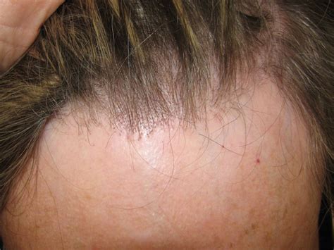 Frontal Fibrosing Alopecia | Treatment & Management | Point of Care