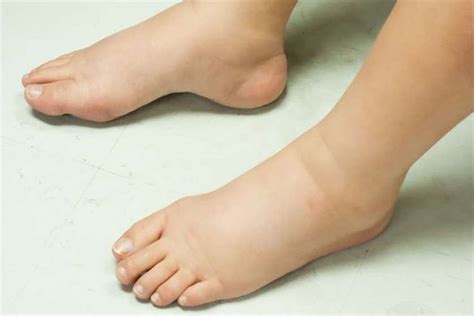 How to get rid of Swollen Feet after giving Birth? | Swollen feet ...