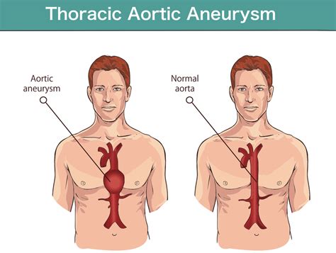 Thoracic Aortic Aneurysm - dlaczego-akurat-my