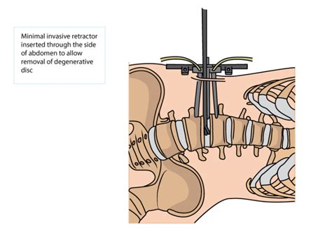 Minimally Invasive Oblique Lumbar Interbody Fusion (OLIF) and Lateral Lumbar Interbody Fusion ...