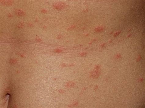 Severe Pityriasis Rosea