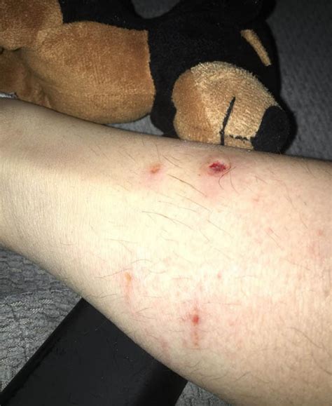 Fearing rabies, Nunavik woman complains about slow treatment of fox bite | Nunatsiaq News