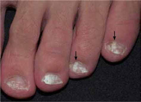 White superficial onychomycosis - WikiProjectMed