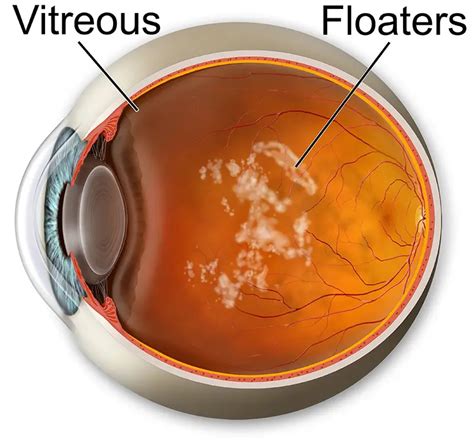 Floaters | Flashes | Matossian Eye Associates | Doylestown PA ...