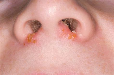 Staph Infection In Nose at Charles Bolt blog