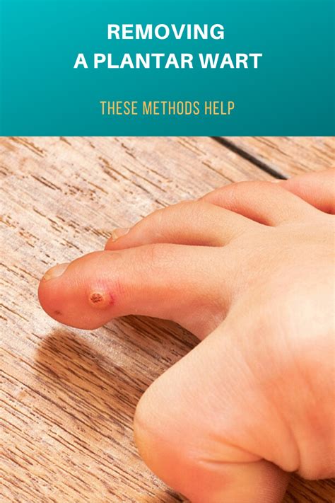 Removing a Plantar Wart: These Methods Help | Warts remedy, Warts, Foot warts