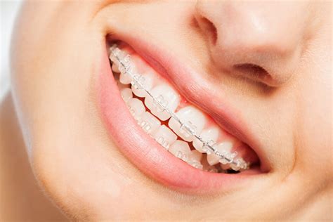 What Causes Crooked Teeth?