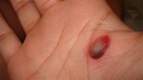 Blood Blisters: Symptoms, Causes, and Treatment