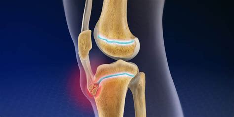 Quick Facts on Osgood-Schlatter Disease | Kinetic Labs