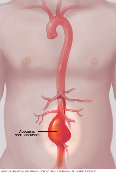 Abdominal aortic aneurysm