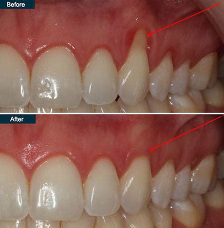 Gingivitis Before And After Treatment
