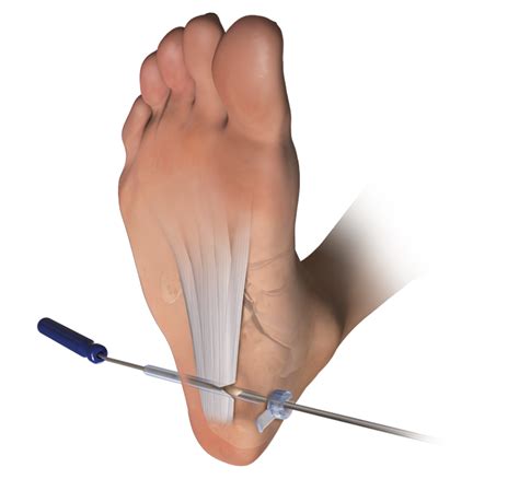 Arthrex - Endoscopic Plantar Fascia