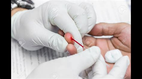 To determine blood clotting time by capillary tube method - YouTube