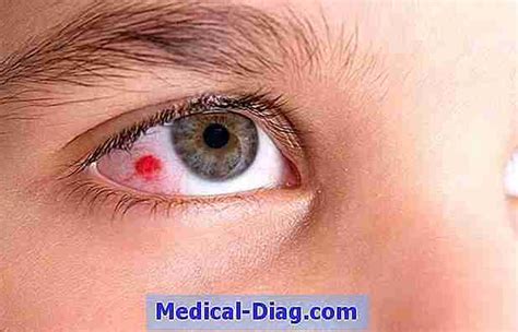 Infektiöse Konjunktivitis (Rosa Auge): Symptome, Diagnose Und Behandlungen (Medical-Diag.com 2024)