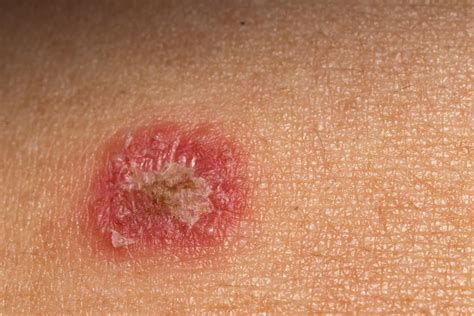 Psoriasis or ringworm? Symptoms, treatment, and other rashes