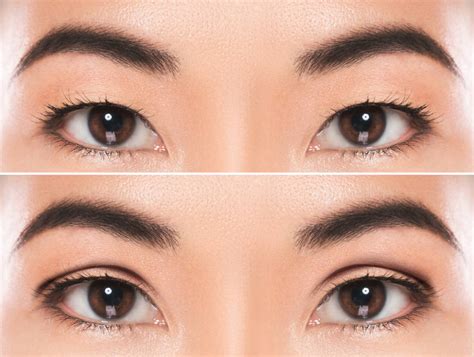 What Are Double Eyelids? - In Focus Ophthalmic Plastic Surgery - Blog