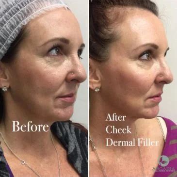 Before and After: Cheek Fillers | Arcadia Wellness Center