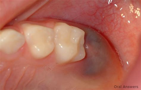 Eruption Cyst: Photos of a Purple Bump on the Gums | Oral Answers