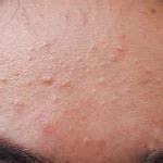 Cystic Acne: Causes, Symptoms, Prevention And Treatment