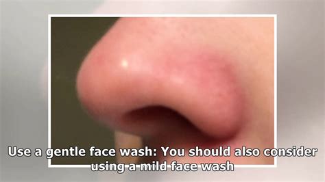 Causes of Redness around Nose and How to Get Rid of Redness Around Nose ...