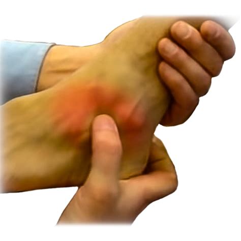 Ankle Instability - Dr Bothma