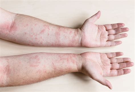 Can Celiac Disease Cause Rashes? | The Well by Northwell