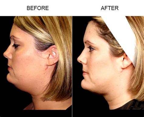 Face Liposuction Before And After