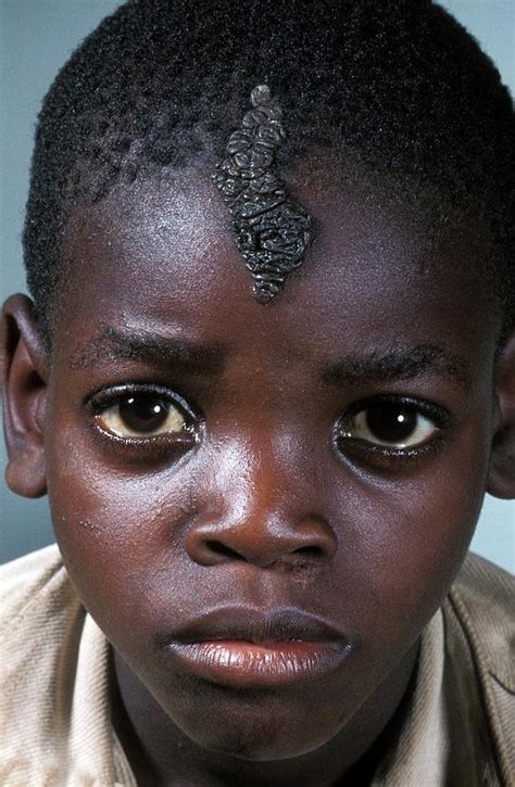 Birthmark Photograph by Dr M.a. Ansary/science Photo Library - Fine Art ...