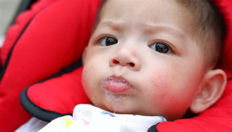 Drool Rash vs Eczema: How to Tell the Difference | WonderBaby.org