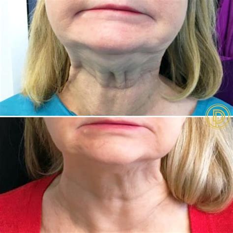 Neck Botox Dallas | Botox Neck Injections Dallas | Botox for Neck Bands ...