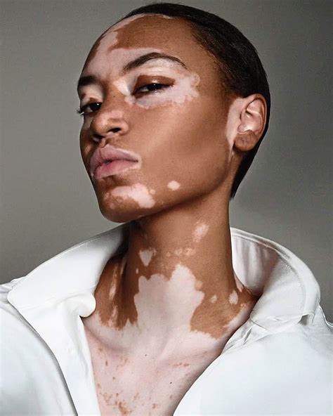 Vitiligo: What Is It And How Can I Get Rid Of It? - shoreshim