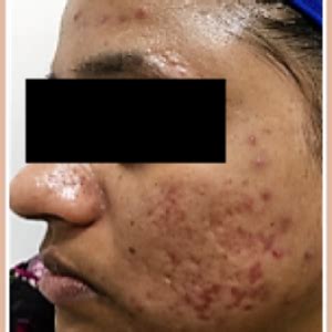 Acne Scar Removal Before and after Images – Science of Skin