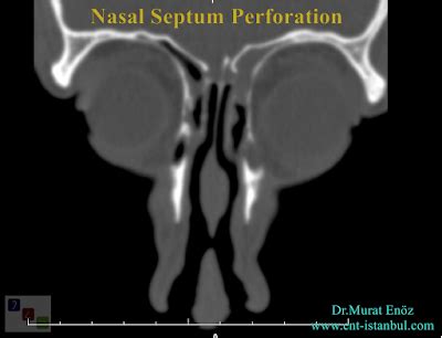 Health Zone Turkey: Symptoms, Causes and Diagnosis of Nasal Septum ...