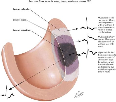 Pin by Lauren Clayton on AMI | Heart disease, Disease, Heart