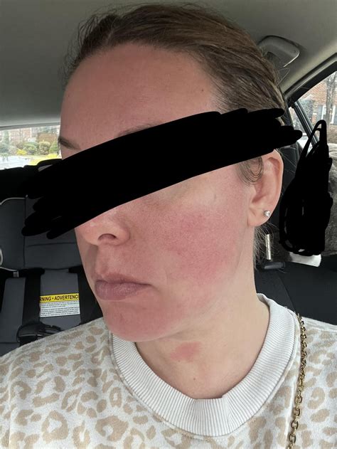 Sunburn-like rash on face : r/Dermatology