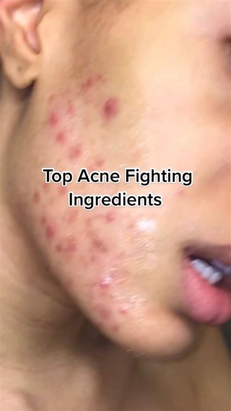 Acne fighting ingredients for acne treatment from a esthetician oily acne prone skin skincare ...