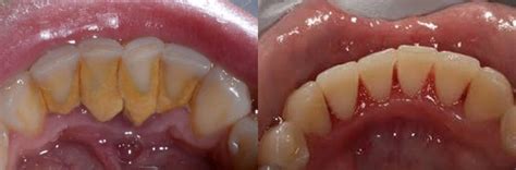 Oral Debridement | Spring Hill Dental Associates