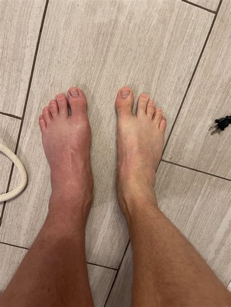 What gout looks like. So very painful : r/mildlyinteresting