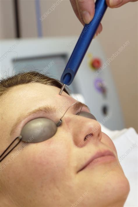 Laser wrinkle treatment - Stock Image - M590/0238 - Science Photo Library