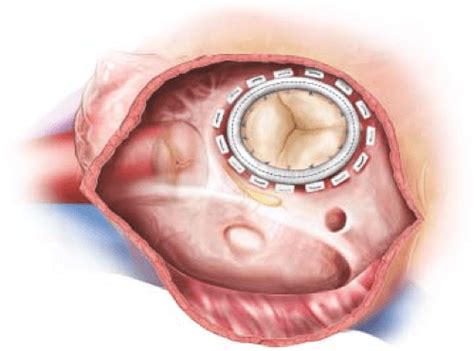 Tricuspid Valve Repair and Replacement | Thoracic Key