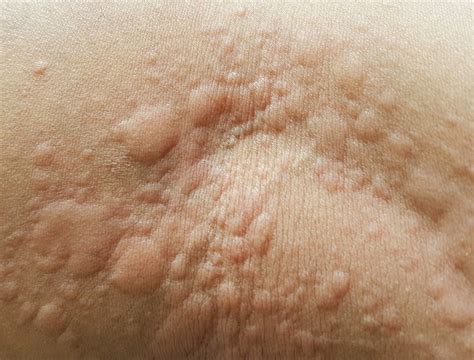 What are hives, the common skin condition that gives you itchy, red bumps?