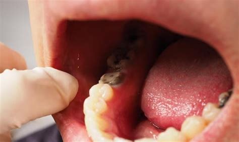 What are the signs of sepsis from tooth infection? | by Belmont ...