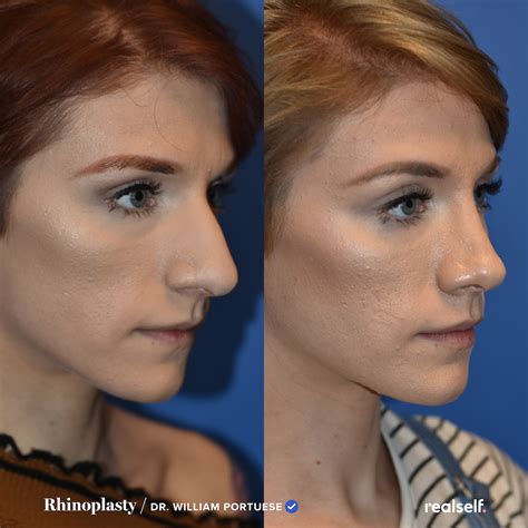 Rhinoplasty Recovery