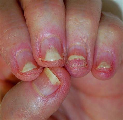 Nail Deformities and Dystrophies - Dermatologic Disorders - MSD Manual ...