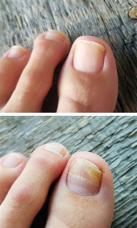 Genehmigung ich trage Kleidung Pastell pinpoint laser toenail fungus Verschmutzung Habubu Ermittlung